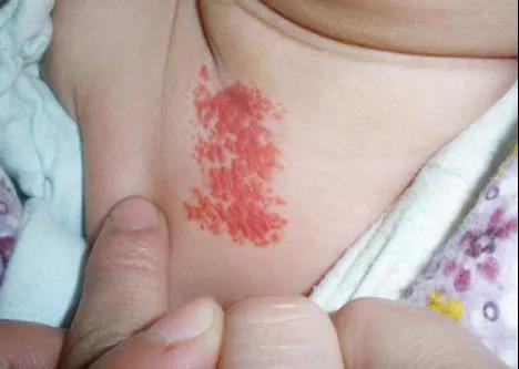 毛细血管瘤,婴儿湿疹,成都川蜀血管病医院